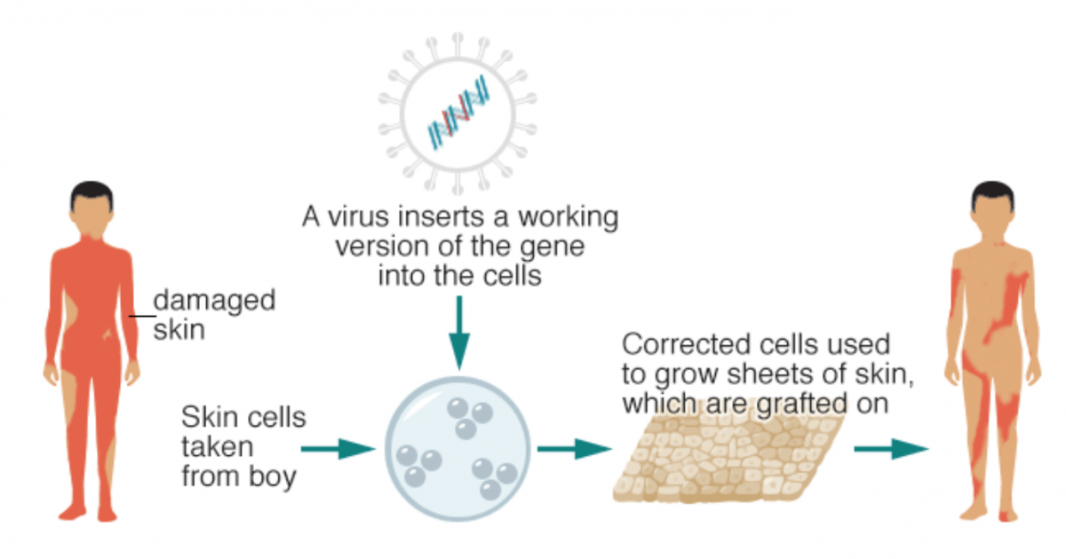 Breakthrough use of transgenic stem cells in treating